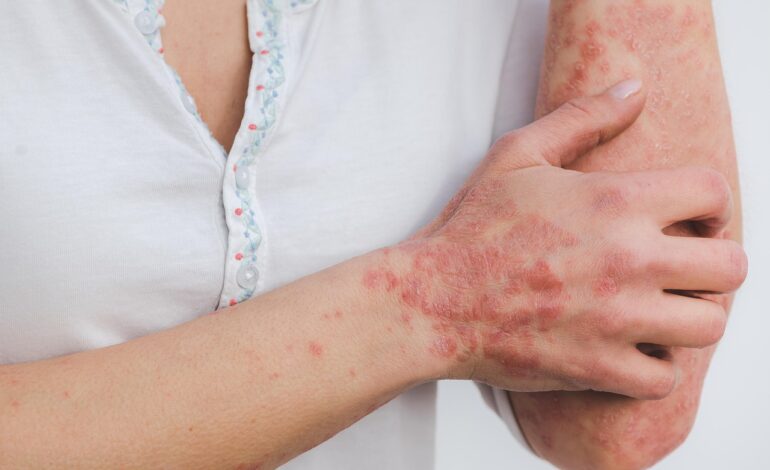 Psoriasis in Women: How It Differs, Why It Matters, and What to Watch For