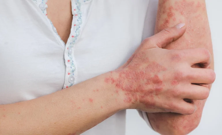 Psoriasis in Women: How It Differs, Why It Matters, and What to Watch For