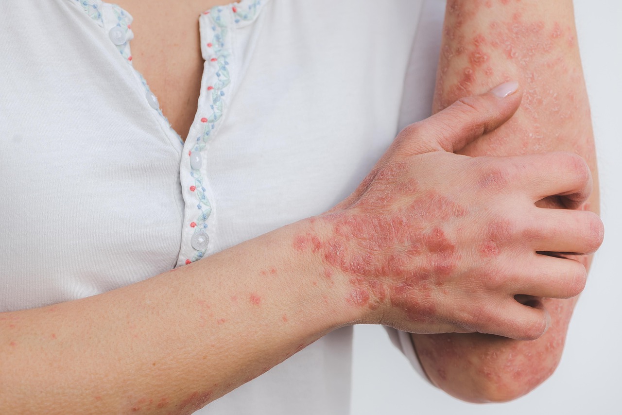 Psoriasis in Women: How It Differs, Why It Matters, and What to Watch For