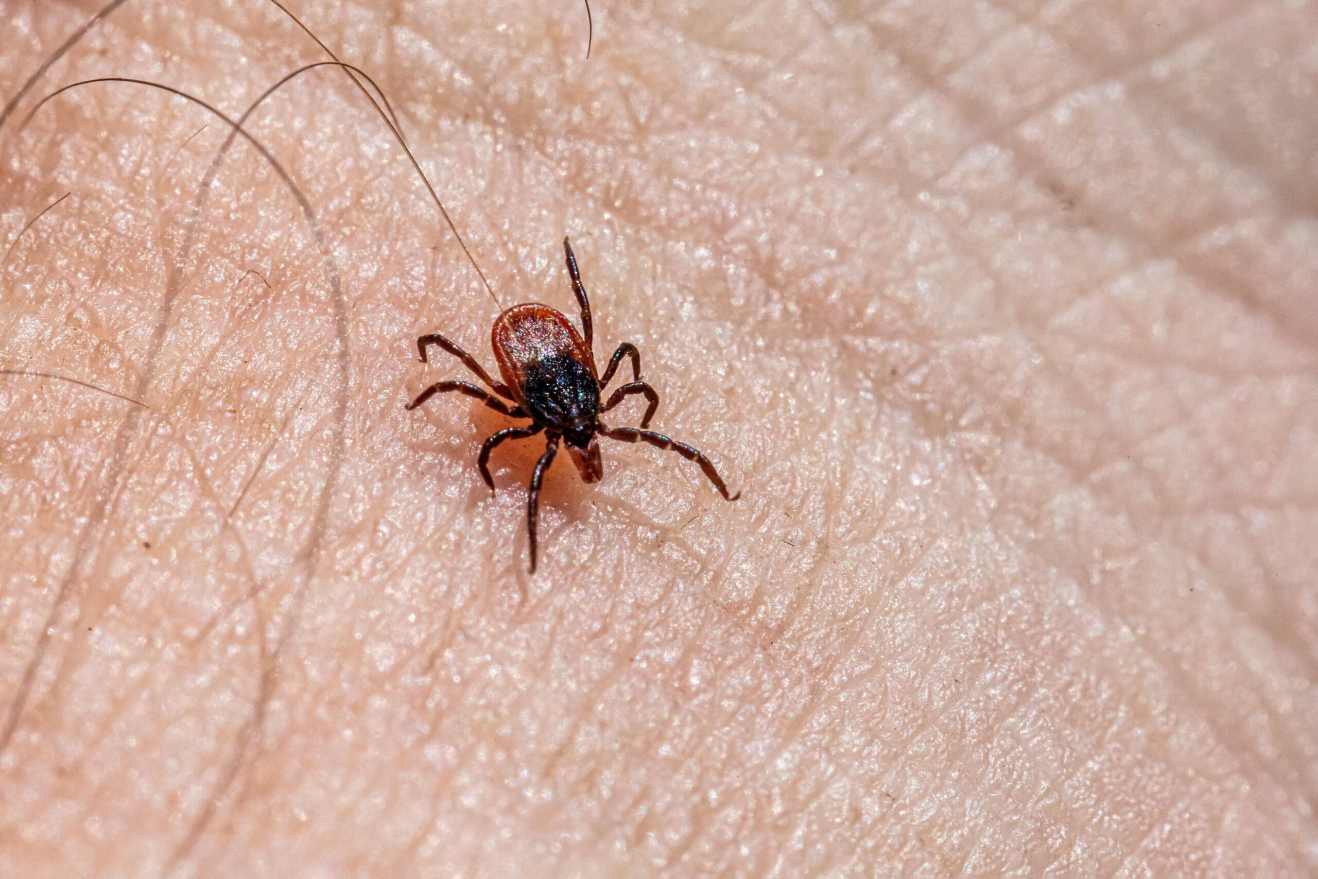 Ticked Off: When a Tick Bite Becomes a Health Emergency”