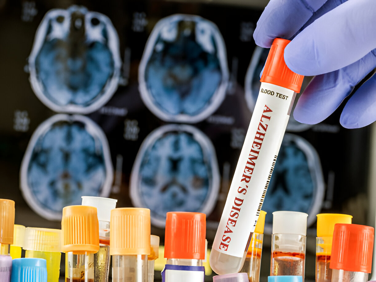 A Basic Blood Test Could Predict How Fast You’ll Lose Memory From Alzheimer’s