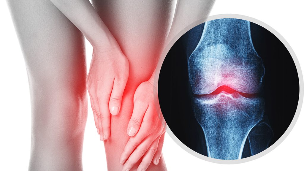 Osteoporosis in Women: My Wake-Up Call and What Every Woman Should Know