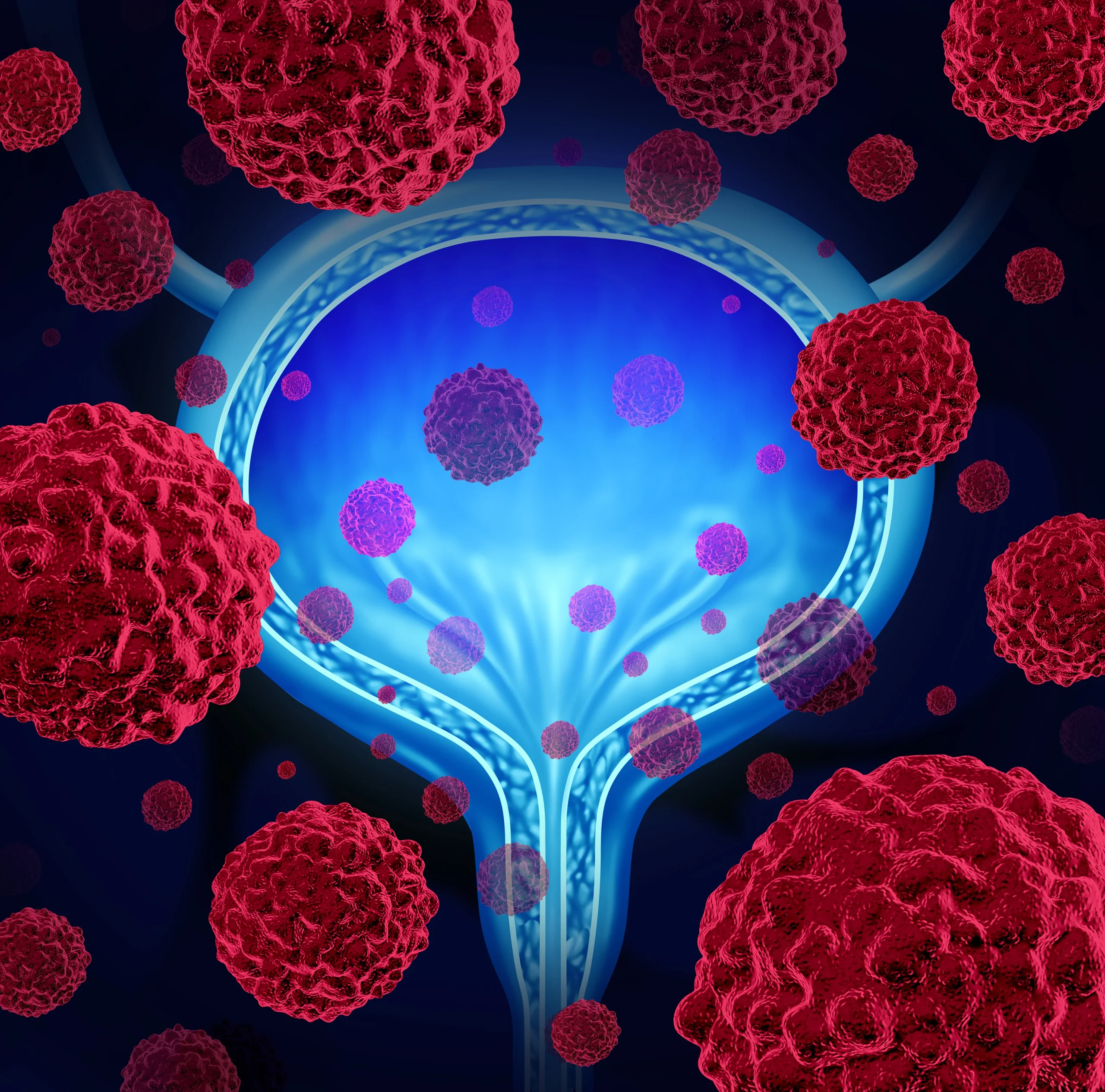 The Cancer No One Talks About: Why Bladder Cancer Remains in the Shadows