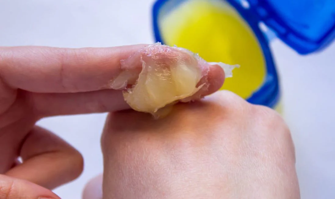 Vaseline: What We Grew Up Using—and What We Should Know Now