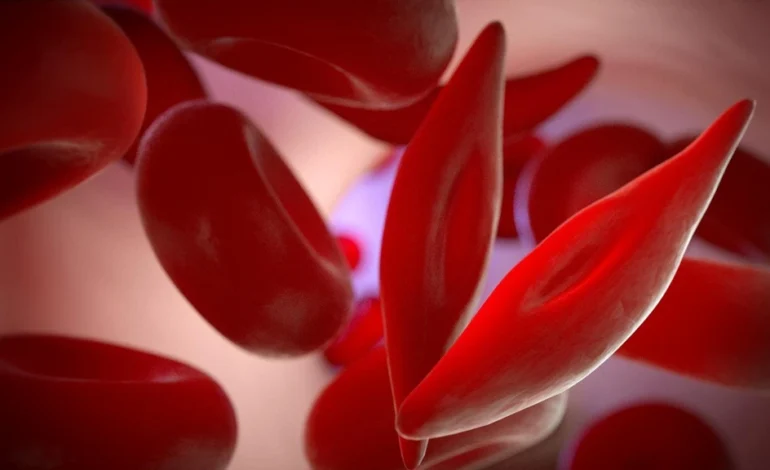 Sickle Cell Disease: The Silent Crisis Millions Are Living With