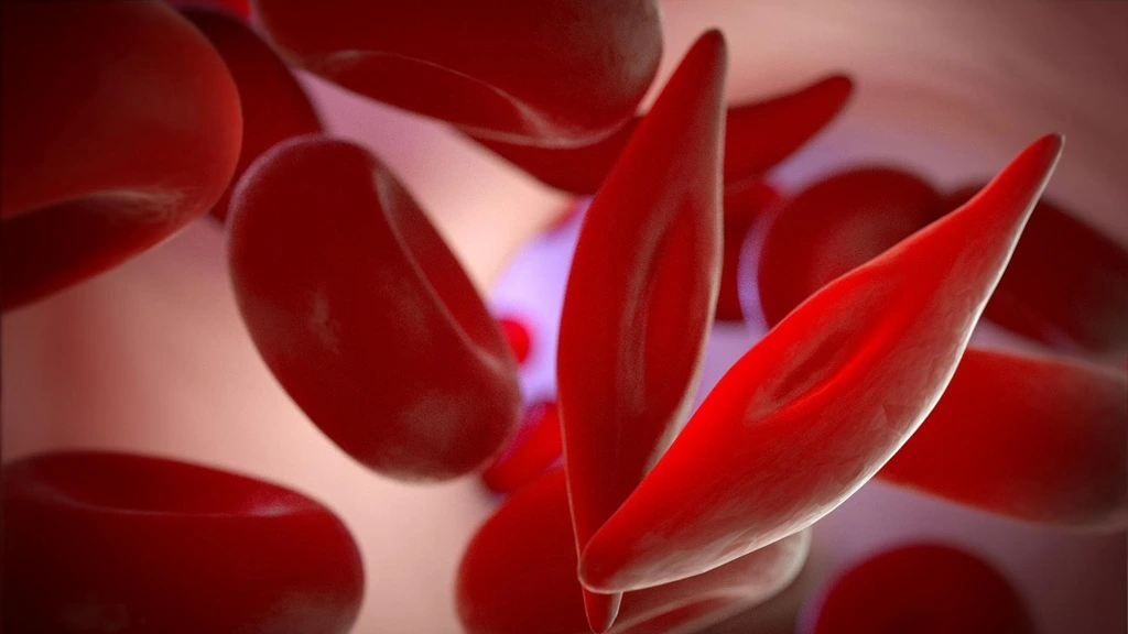 Sickle Cell Disease: The Silent Crisis Millions Are Living With
