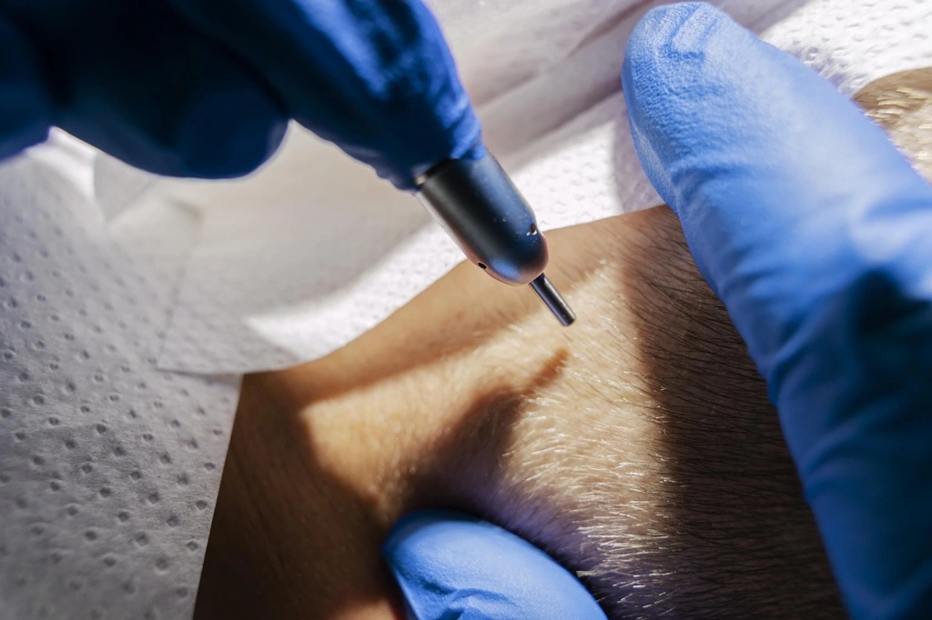 microneedling for hair loss